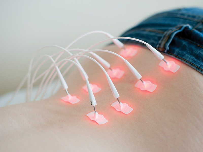 laseracupunctuur